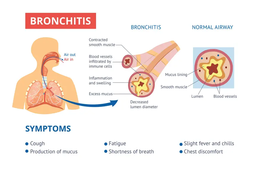 Bronchitis